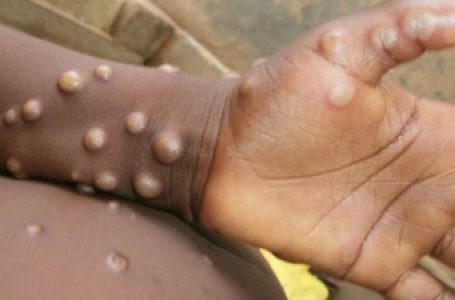 Telangana’s first suspected monkeypox case tests negative