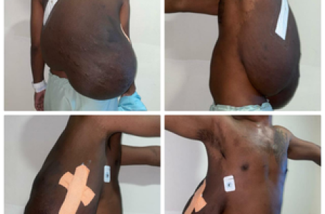 16.7 kg tumour ‘hanging like a gunny bag’ removed from man’s back